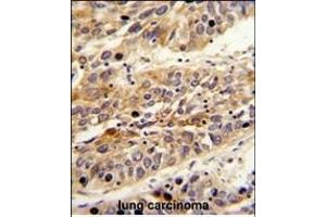 Formalin-fixed and paraffin-embedded human lung carcinoma reacted with LRG1 Antibody (Center), which was peroxidase-conjugated to the secondary antibody, followed by DAB staining.
