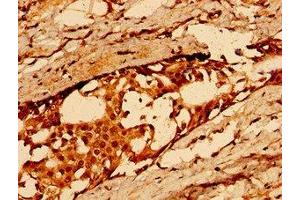 Immunohistochemistry of paraffin-embedded human breast cancer using ABIN7163584 at dilution of 1:100