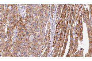 ABIN6267116 at 1/100 staining Human thyroid cancer tissue by IHC-P. (FLT3 anticorps  (pTyr969))