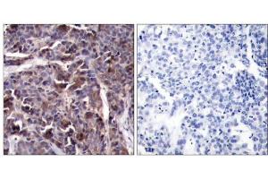 Immunohistochemical analysis of paraffin-embedded human breast carcinoma tissue using NFκB-p65 (Phospho-Thr505) Antibody (E011166). (NF-kB p65 anticorps  (pThr505))