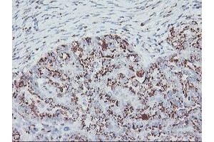 Immunohistochemical staining of paraffin-embedded Adenocarcinoma of Human ovary tissue using anti-GOLM1 mouse monoclonal antibody. (GOLM1 anticorps)