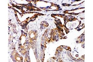 IHC-P: DCC antibody testing of human intestinal cancer tissue