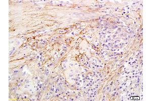 Formalin-fixed and paraffin embedded human colon carcinoma labeled with Anti-Hyaluronidase-1 Polyclonal Antibody, Unconjugated (ABIN673779) at 1:300 followed by conjugation to the secondary antibody and DAB staining