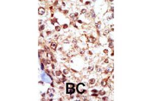 Formalin-fixed and paraffin-embedded human cancer tissue reacted with FGR polyclonal antibody  , which was peroxidase-conjugated to the secondary antibody, followed by AEC staining. (Fgr anticorps  (N-Term))