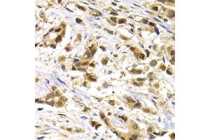Immunohistochemistry of paraffin-embedded human breast cancer using MAGE-1/MA antibody (ABIN6132325, ABIN6143435, ABIN6143436 and ABIN6221133) at dilution of 1:200 (40x lens).