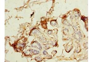Immunohistochemistry of paraffin-embedded human breast cancer using ABIN7159277 at dilution of 1:100 (MAGEA9 anticorps  (AA 1-315))