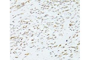 Immunohistochemistry of paraffin-embedded Human uterine cancer using TRIM15 Polyclonal Antibody at dilution of 1:100 (40x lens). (TRIM15 anticorps)