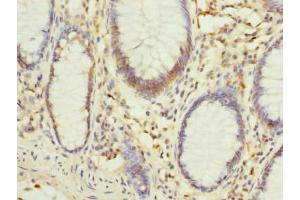 Immunohistochemistry of paraffin-embedded human colon cancer using ABIN7163042 at dilution of 1:100