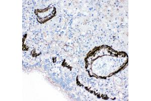 Anti-FABP6 antibody, IHC(P) IHC(P): Human Lung Cancer Tissue (FABP6 anticorps  (N-Term))
