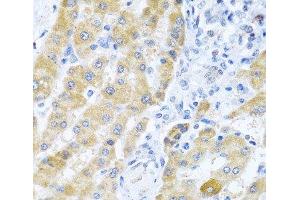 Immunohistochemistry of paraffin-embedded Human liver cancer using Gm13125 Polyclonal Antibody at dilution of 1:100 (40x lens). (Pramel15 anticorps)