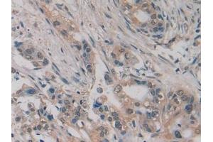 Detection of Slit2 in Human Pancreatic cancer Tissue using Polyclonal Antibody to Slit Homolog 2 (Slit2)