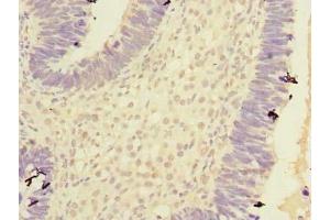 Immunohistochemistry of paraffin-embedded human ovarian cancer using ABIN7146760 at dilution of 1:100 (Carboxypeptidase A2 anticorps  (AA 115-419))