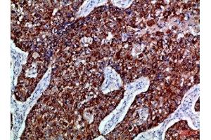 Immunohistochemical analysis of paraffin-embedded Human-lung-cancer, antibody was diluted at 1:100