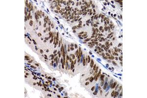 Immunohistochemistry of paraffin-embedded human colon cancer using MT2A antibody (ABIN1873764) at dilution of 1:200 (40x lens). (MT2A anticorps)
