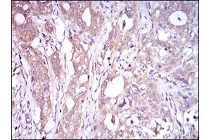 Immunohistochemical analysis of paraffin-embedded cervical cancer tissues using CD93 mouse mAb with DAB staining. (CD93 anticorps  (AA 474-535))