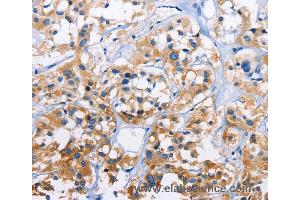 Immunohistochemistry of Human thyroid cancer using CAPZA3 Polyclonal Antibody at dilution of 1:70 (CAPZA3 anticorps)