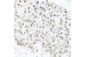 Immunohistochemistry of paraffin-embedded human lung cancer using CETN3 antibody at dilution of 1:100 (x40 lens). (CETN3 anticorps)