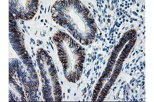 Immunohistochemical staining of paraffin-embedded Adenocarcinoma of Human endometrium tissue using anti-SOCS3 mouse monoclonal antibody. (SOCS3 anticorps)
