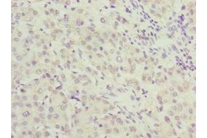 Immunohistochemistry of paraffin-embedded human liver cancer using ABIN7167643 at dilution of 1:100 (RENT2/UPF2 anticorps  (AA 1153-1272))