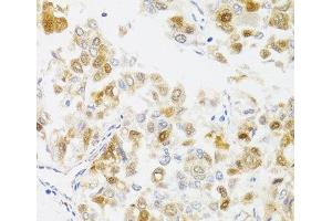 Immunohistochemistry of paraffin-embedded Human liver cancer using MYO5A Polyclonal Antibody at dilution of 1:100 (40x lens). (MYO5A anticorps)