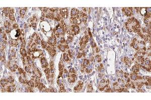ABIN6278511 at 1/100 staining Human liver cancer tissue by IHC-P. (SLC26A5 anticorps  (Internal Region))