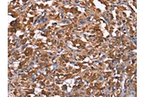 The image on the left is immunohistochemistry of paraffin-embedded Human thyroid cancer tissue using ABIN7191000(HRASLS2 Antibody) at dilution 1/40, on the right is treated with synthetic peptide. (HRASLS2 anticorps)