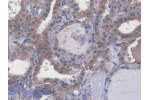 DAB staining on IHC-P; Samples: Human Thyroid cancer Tissue (Esophageal Cancer Related Gene 4 (AA 32-148) anticorps)