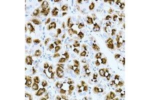 Immunohistochemical analysis of Rac 1 staining in human gastric cancer formalin fixed paraffin embedded tissue section.