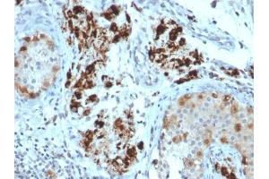 Formalin-fixed, paraffin-embedded human Testicular Carcinoma stained with StAR Mouse Monoclonal Antibody (STAR/2154). (STAR anticorps  (AA 39-108))