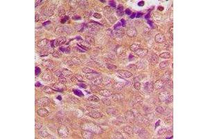 Immunohistochemical analysis of PSMC3 staining in human breast cancer formalin fixed paraffin embedded tissue section. (PSMC3 anticorps)