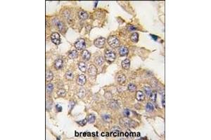 Formalin-fixed and paraffin-embedded human breast carcinoma tissue reacted with ERK2 antibody (C-term) (ABIN391720 and ABIN2841610) , which was peroxidase-conjugated to the secondary antibody, followed by DAB staining. (ERK2 anticorps  (C-Term))