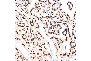 Immunohistochemistry of paraffin-embedded human thyroid cancer using B Rabbit mAb (ABIN7265377) at dilution of 1:100 (40x lens).