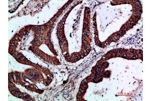 Immunohistochemical analysis of paraffin-embedded human-colon-cancer, antibody was diluted at 1:200. (GREM2 anticorps  (AA 71-120))