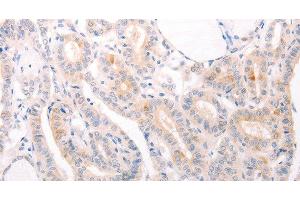 Immunohistochemistry of paraffin-embedded Human thyroid cancer using EDG3 Polyclonal Antibody at dilution of 1:30 (S1PR3 anticorps)