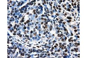 Immunohistochemical staining of paraffin-embedded Adenocarcinoma of breast tissue using anti-PSMC3 mouse monoclonal antibody.