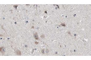ABIN6272884 at 1/100 staining Human brain cancer tissue by IHC-P.