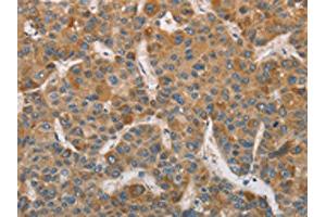 The image on the left is immunohistochemistry of paraffin-embedded Human liver cancer tissue using ABIN7129185(DDX53 Antibody) at dilution 1/75, on the right is treated with fusion protein. (DDX53 anticorps)