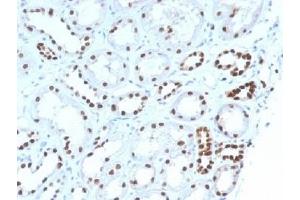 IHC testing of FFPE human renal cell carcinoma with PAX8 antibody (clone PAX8/1492).