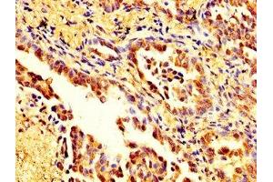 IHC image of ABIN7160125 diluted at 1:200 and staining in paraffin-embedded human lung cancer performed on a Leica BondTM system. (Moesin anticorps  (AA 466-572))
