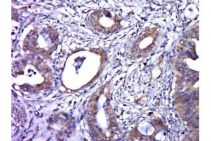 Paraformaldehyde-fixed, paraffin embedded human cervical cancer, Antigen retrieval by boiling in sodium citrate buffer (pH6. (Humain Papilloma Virus 16 E6 (HPV-16 E6) (AA 85-158) anticorps)