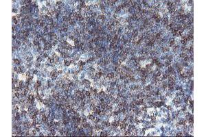 Immunohistochemical staining of paraffin-embedded Human lymphoma tissue using anti-DPH2 mouse monoclonal antibody. (DPH2 anticorps)