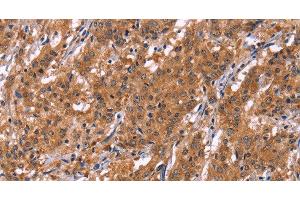 Immunohistochemistry of paraffin-embedded Human gastric cancer tissue using HLTF Polyclonal Antibody at dilution 1:30 (HLTF anticorps)