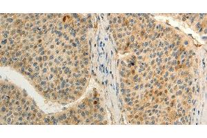 Immunohistochemistry of paraffin-embedded Human liver cancer tissue using FZD8 Polyclonal Antibody at dilution 1:50 (FZD8 anticorps)