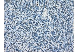 Immunohistochemical staining of paraffin-embedded Adenocarcinoma of breast tissue using anti-POR mouse monoclonal antibody. (POR anticorps)