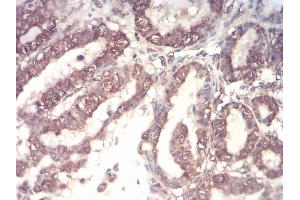 Immunohistochemical analysis of paraffin-embedded esophageal cancer tissues using CSF3 mouse mAb with DAB staining.