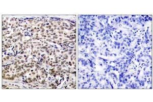 Immunohistochemical analysis of paraffin-embedded human breast carcinoma tissue using CREB (Ab-129) antibody (E021265). (CREB1 anticorps)