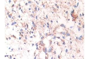 Detection of Hsp60 in Human Glioma Tissue using Polyclonal Antibody to Heat Shock Protein 60 (Hsp60)