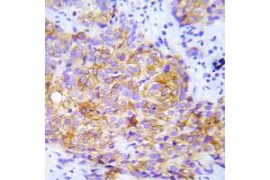 Immunohistochemical analysis of paraffin-embedded human lung adenocarcinoma tissue using CrkL (Phospho-Try207) Antibody (E012071). (CrkL anticorps  (pTry207))