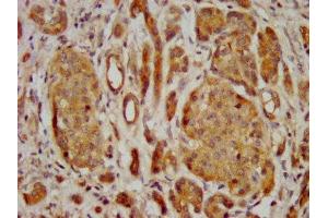 IHC image of ABIN7153155 diluted at 1:400 and staining in paraffin-embedded human pancreatic cancer performed on a Leica BondTM system.