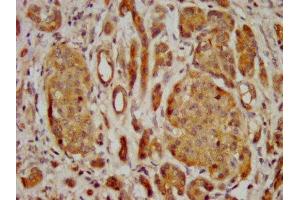 IHC image of ABIN7153155 diluted at 1:400 and staining in paraffin-embedded human pancreatic cancer performed on a Leica BondTM system. (FREM2 anticorps  (AA 1986-2127))